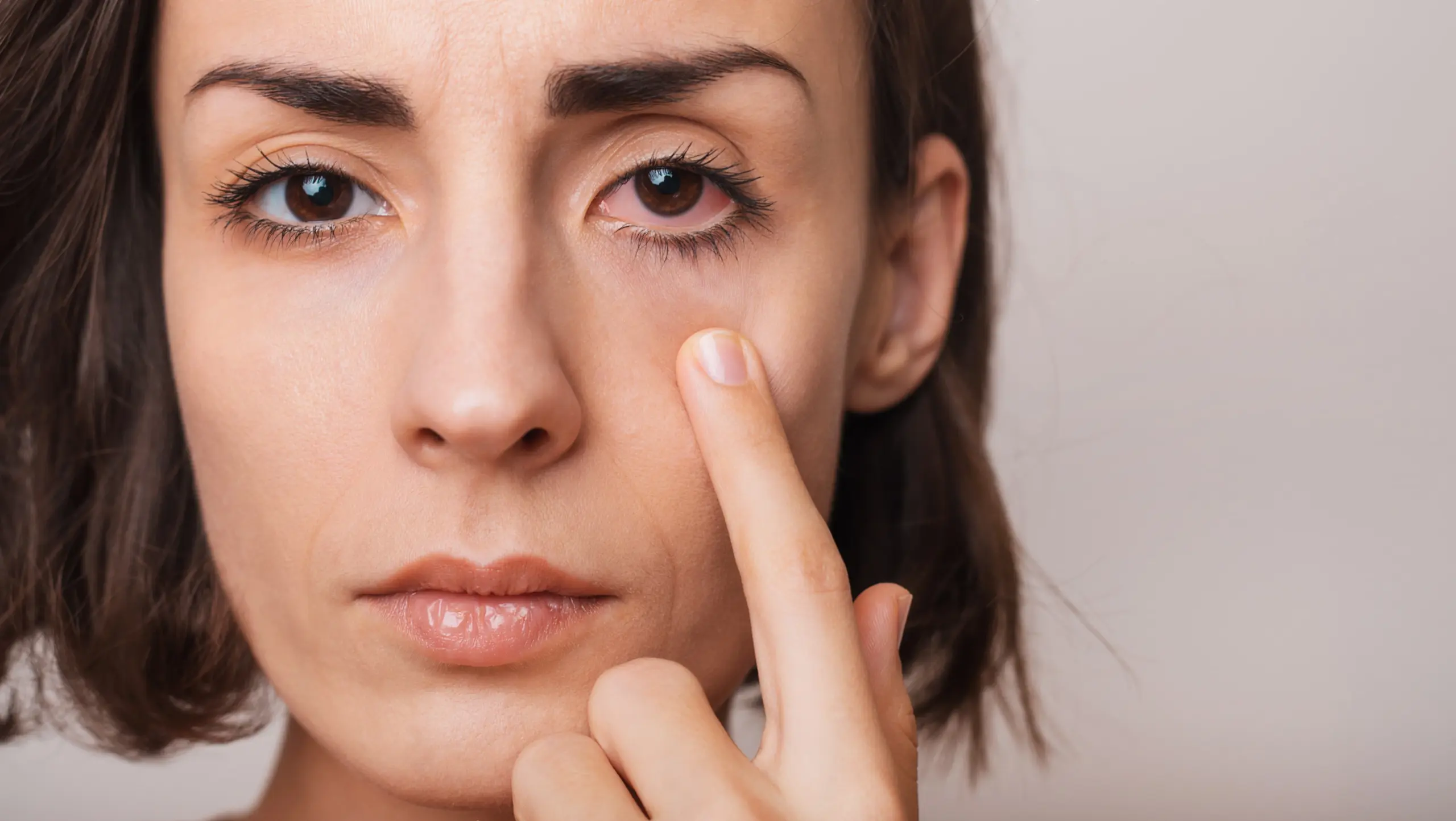 person with bloodshot eyes showing physical symptoms of addiction